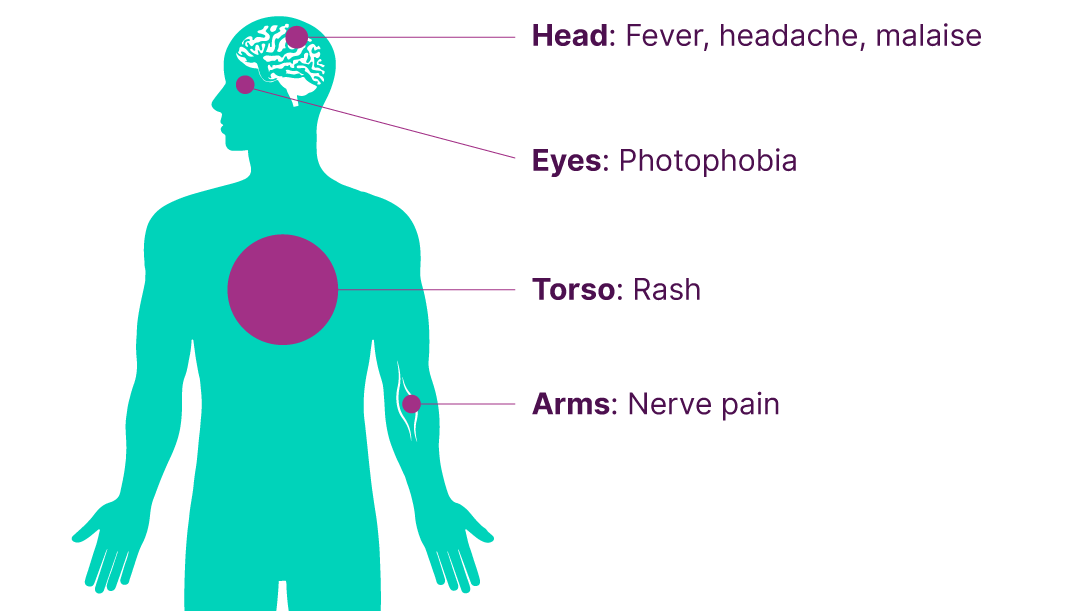 Diagrammatic figure of person with labels showing the symptoms of shingles